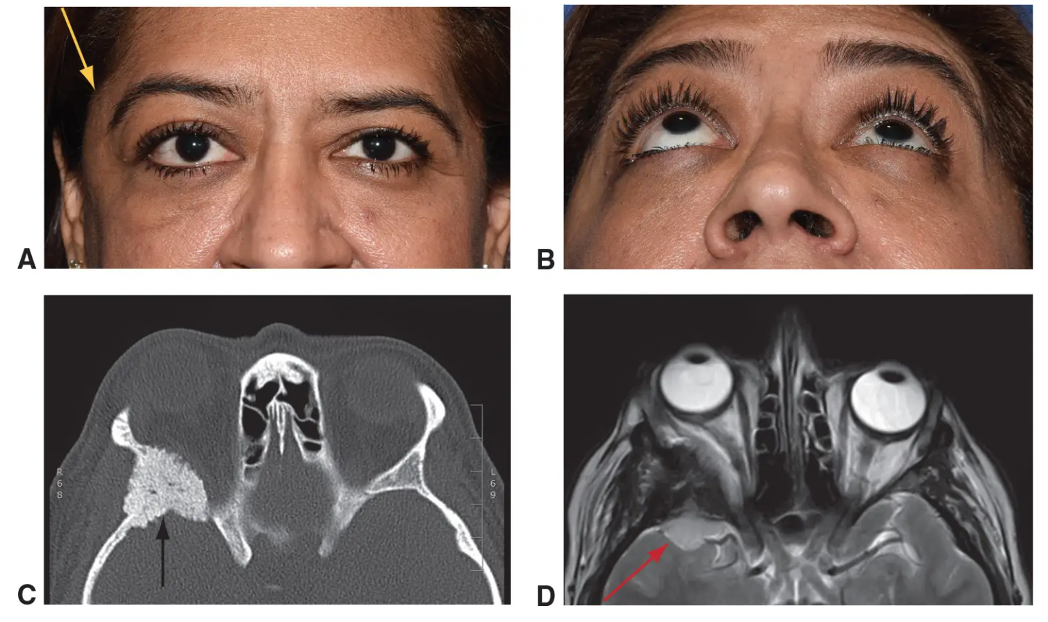 Text Eyelid, Lacrimal, and Orbital DiseaseAdult Orbital NeoplasmsMeningiomas of the orbit can