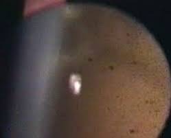 Extra Shafer's sign Also called