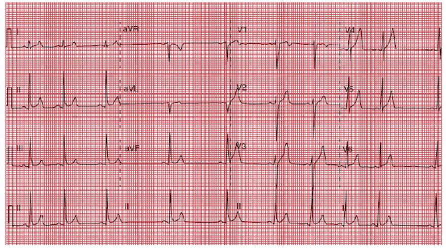 Text Identify the EKG rhythm