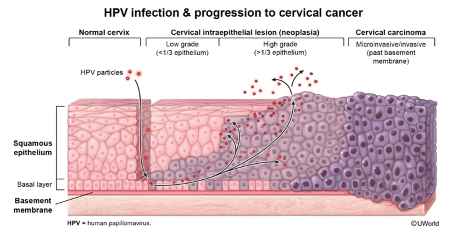 Extra low grade cin high grade cin involves 1 3 epithelium and