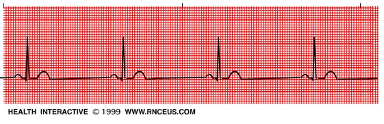 Back Sinus bradycardia