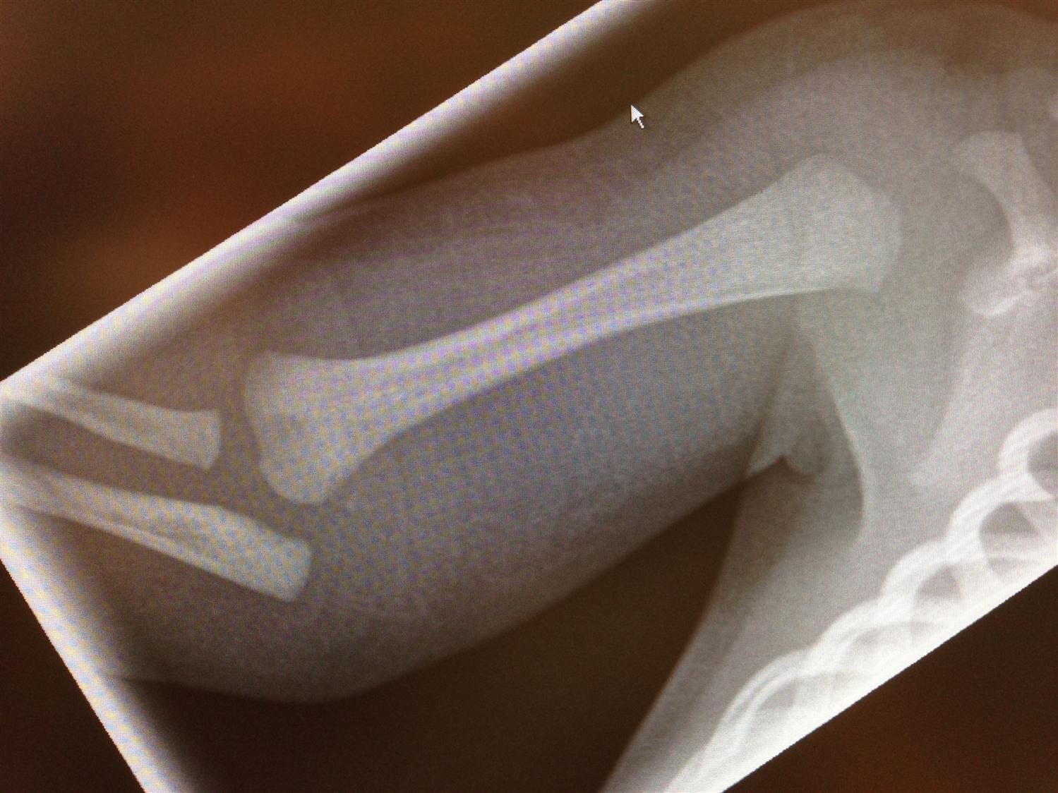 Often associated w/ non-accidental trauma