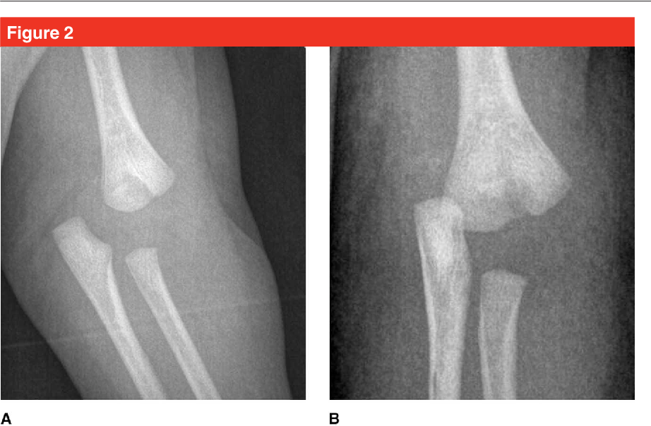 Often associated w/ non-accidental trauma