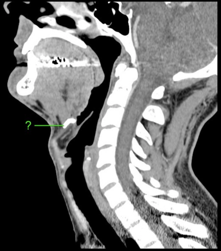 Text {{c1::Hyoid bone::Structure?}}