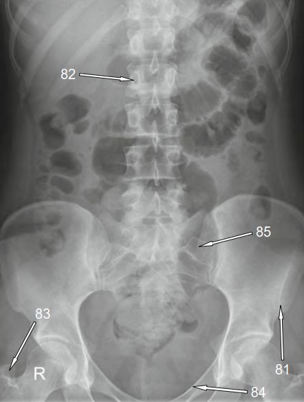Romanulus Radiopaedia Front