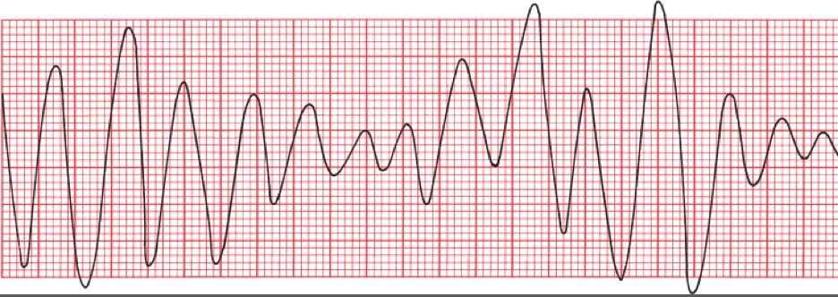 {{c1::torsades de pointes}}