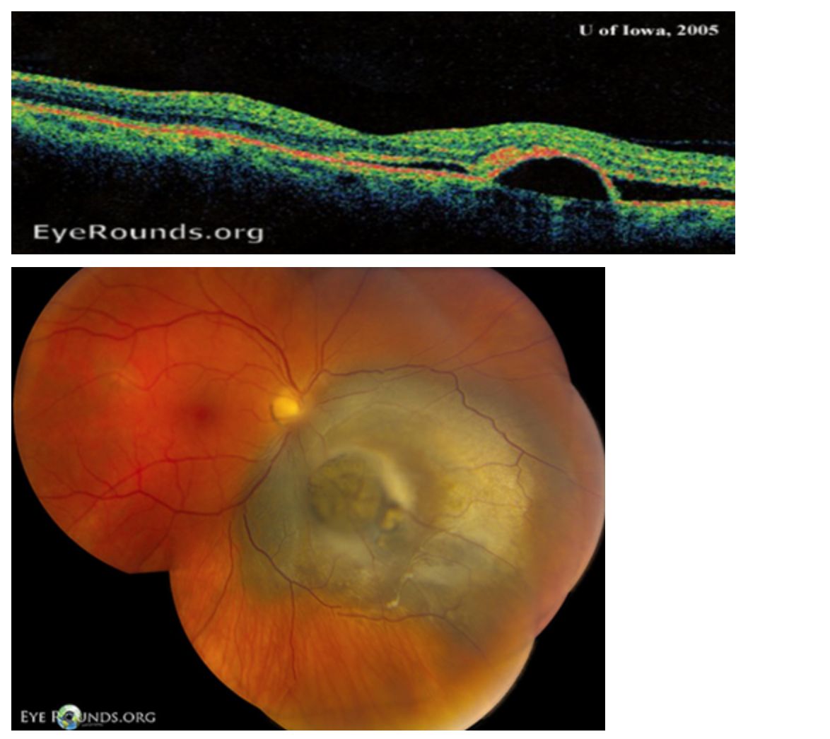 Tags AAO_OphthalmologyChapter9OcularManifestations