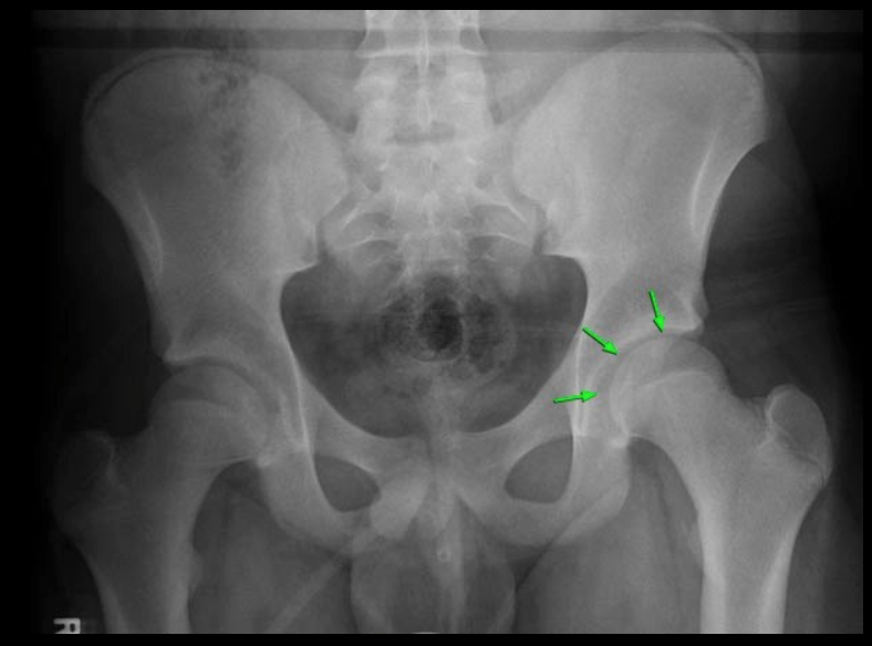 Text {{c1::Acetabulum::Structure?}}