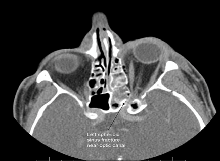 Tags AAO_Ophthalmology::Chapter5::Ocular&OrbitalInjuries