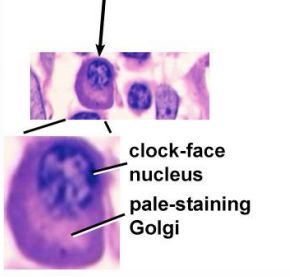 plasma cell clock face